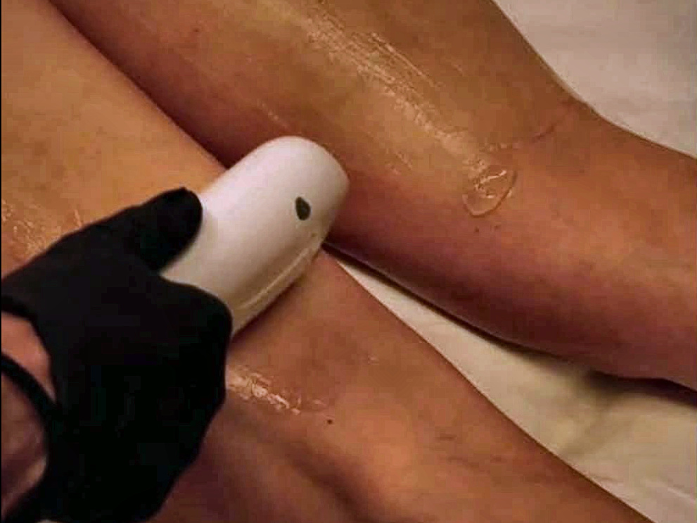 Laser hair removal, carried out by HJ Skin & Laser Clinic